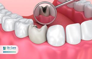 Sản phẩm đặc trị sâu răng gia truyền hiệu quả nhất hiện nay