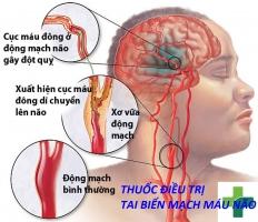 Sản phẩm hỗ trợ điều trị tai biến mạch máu não hiệu quả nhất