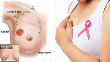 Bệnh ung thư thường gặp ở phụ nữ và cách phòng tránh