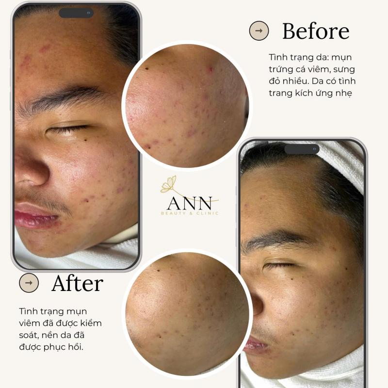 ANN Beauty & Clinic - Spa Trị Mụn Hiệu Quả, Chuẩn Y Khoa Tại Đà Lạt