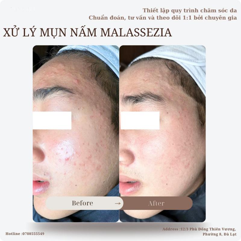 Dung Nhi Beauty Spa - Spa Trị Mụn Uy Tín, An Toàn