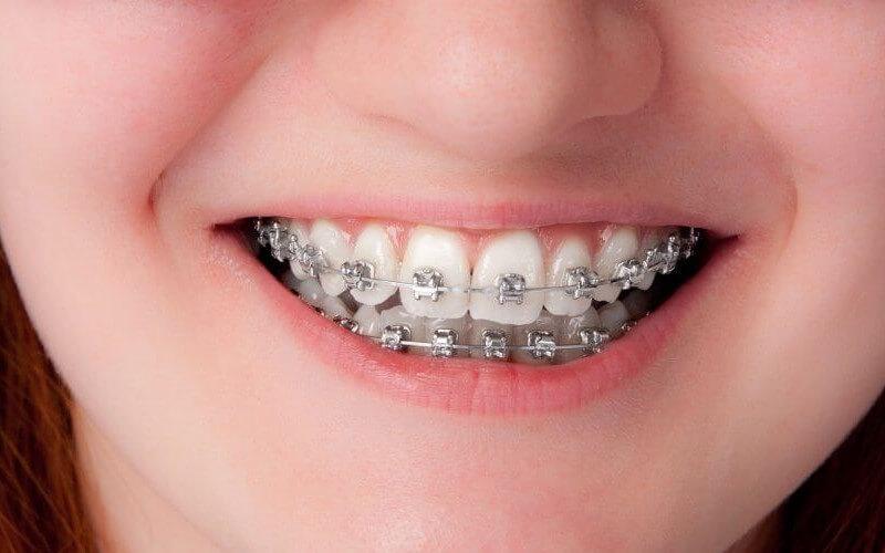 Niềng răng thẩm mỹ luôn là sự lựa chọn hàng đầu tại NHA Khoa Đồng Khởi, niềng răng là phương pháp giúp bạn luôn có một nụ cười hoàn hảo.