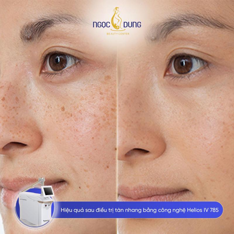 Khách hàng trị nám tại Ngọc Dung